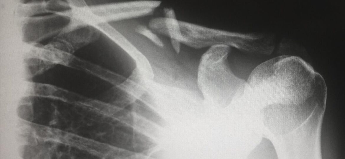 X-Ray of a broken bone